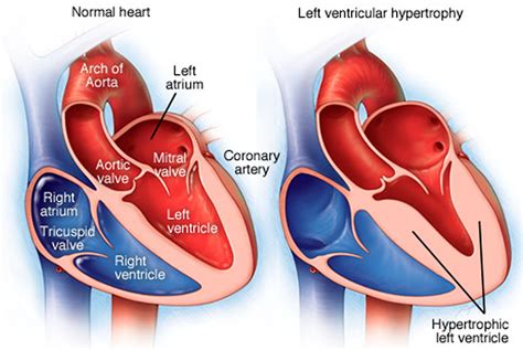 what is mild Lv hypertrophy